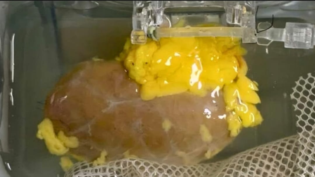 Scientists develop ‘universal’ kidney that can match any blood group